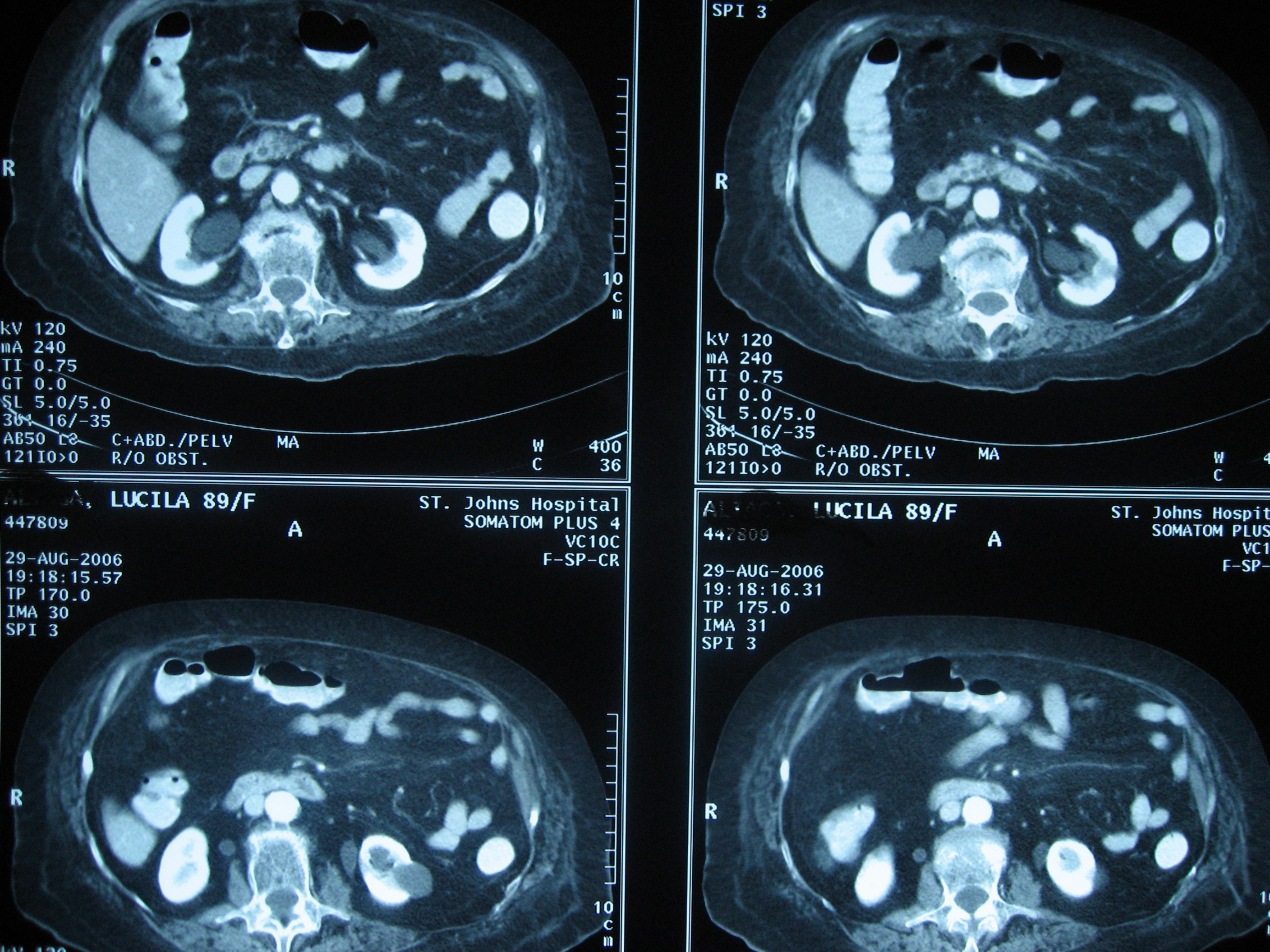 Index of /pa/PAC13 Diagnostic Imaging II/Archive/8Gu/Extrarenal Pelvis